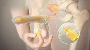 Image result for Penile Prosthesis