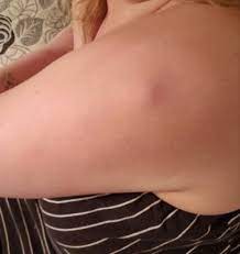 Tdap Vaccine Swelling February 2019 Birth Club Babycenter Canada