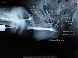 Image result for Retrograde Urethrogram