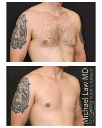 Image result for Gynecomastia