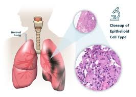 When patients know that they regularly contact asbestos, they should take the early symptoms as signs and get tested. Pleural Mesothelioma Stages Treatment Prognosis