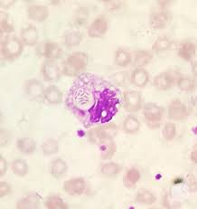 Image result for Peripheral Smear
