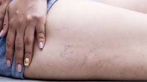 La trombosis venosa profunda, o tvp ocurre cuando un coágulo sanguíneo se forma en una de las venas profundas del cuerpo. Como Detectar La Trombosis Venosa Profunda Tn