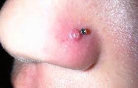 It is a useful home remedy for. Nose Piercing Bump 6 Causes And How To Treat Them Authoritytattoo