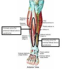 Shin pain is experienced on the front of the lower leg, below it can hurt directly over the shinbone (tibia) or over the muscles that are on the inner or outer side of the. Medial Tibial Stress Syndrome Shin Splints Treatment And Symptoms Vivomed