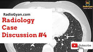 Lady Windermere Syndrome Mac Infection Radiology Board Review Case Youtube