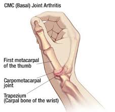 CMC Thumb Arthritis - Causes, Symptoms, Treatment | Oh My Arthritis