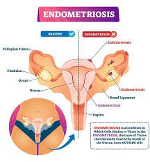 Scotchie shares, endometriosis is challenging because some women will have no symptoms, and other women who have all of the symptoms above may not necessarily have endometriosis. after taking into consideration all of the. Endometriosis How Do I Know If I Have Endometriosis How Do You Cure It Express Co Uk