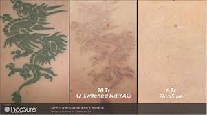 We provide a state of the art laser capable of removing a broad color spectrum. The Skin Game Change Picosure Revolutionizes Laser Tattoo Removal Plastic Surgery Practice