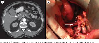 The main advantage of pet is in the detection of metastatic disease and clarifying uncertain ct findings in the liver. Figure 1 From Advanced Stage Pancreatic Cancer Therapy Options Semantic Scholar