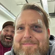 RTL: Axel Stein zeigt heftige Verletzung vom Dreh