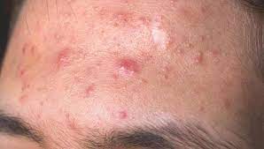 And perhaps worst of all, a pimple under the skin can scar if you give in to the temptation of squeezing. Blind Pimple Under The Skin 6 Ways To Treat It
