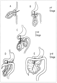 Image result for Intestinal Malrotation
