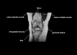 Overuse injuries of the knee include tendonitis, bursitis, muscle strains, and iliotibial band syndrome. Knee Anatomy Mri Knee Coronal Anatomy Free Cross Sectional Anatomy