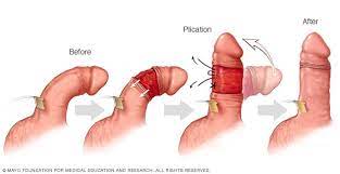 These are often treated by inserting a wire mesh tube (stent) near the blockage to widen the artery. Peyronie S Disease Diagnosis And Treatment Mayo Clinic
