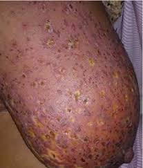 Image result for zoster under breasts