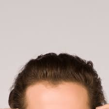 Maybe you would like to learn more about one of these? Why Is My Hairline Uneven How To Combat A Receding Hairline Skalp