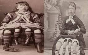 Josephene myrtle corbin, a mulher de quatro pernas, nasceu no condado de lincoln, estado americano do tennessee em 1868. Four Legged Woman From Texas Who Raised Family Despite Her Exceptional Looks The Standard