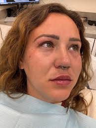 Hi, seeking your help here--- A patient reached out to me wondering if her  case necessitates surgery or orthodontics with 4 premolar extractions. She  is seeking treatment because of functional issues: *