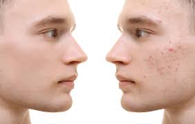 Image result for acne face