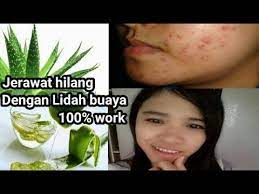 Cara menghilangkan bekas jerawat dengan cepat menggunakan lidah buaya: 2 Cara Cepat Menghilangkan Jerawat Mengunakan Lidah Buaya Youtube