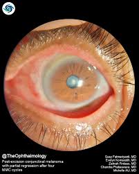 Image result for conjunctival melanoma