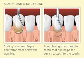 To make matters worse, simple brushing and flossing at home aren't. Deep Cleaning When Do You Need It And Why By Select Dental Medium