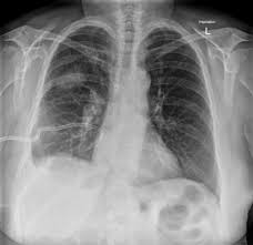 Loculated effusion (shown in the images below) is characterized by an absence of a shift with a change in this case of loculated pleural effusion (e), the configuration of the fluid suggests a free. Parapneumonic Effusion Loculated Radiology Case Radiopaedia Org