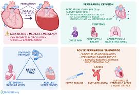 • symptoms of heart failure, • chest pain due to pericardial irritation • symptoms associated with heart block and arrhythmia. Pericardial Tamponade What Is It Causes Pericardial Effusion Signs Diagnosis Treatment And More Osmosis