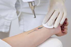 We use four different wavelengths for effective dismantling of even the most popular pigments and ink colors. Laser Tattoo Removal Metro Laser Aesthetics Ny Nj