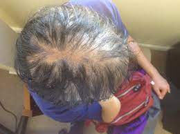 Hair loss isn't usually an indication of a serious health condition but it can be upsetting nonetheless. Hair Loss Case Patient M Your Best Choice For Acupuncture And Herbs