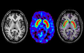 Parkinson's disease is due to the loss of brain cells that produce dopamine. Mri In Parkinson Disease Expanding Usability For Better Diagnostics Neurology Advisor