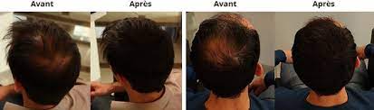 Livraison gratuite en magasin dès 40€ d'achat. Ajf Faux Cheveux Pour Homme Nalan Com Sg