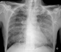 La légionellose est une maladie d'origine bactérienne, potentiellement mortelle. Manifestations Pulmonaires Au Cours De L Infection Par Le Vih Demarche Diagnostique Sciencedirect