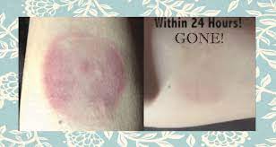 How To Get Rid Of Cupping Marks Quickly Candylipz