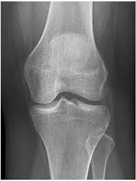 Knee muscles need to have both good strength and flexibility. X Knee Startradiology