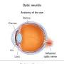 Optic neuritis symptoms from my.clevelandclinic.org