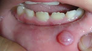 What Are The Symptoms Of Mucocele How To Treat It Naturally Cuidar Da Saude Saude Bucal