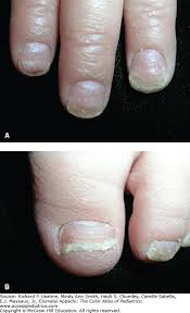 Image result for Pitting nails feet