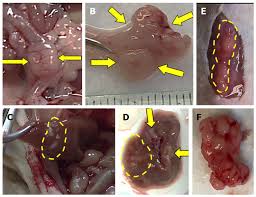 Has the cancer spread to other parts of the body? Two Sides To Colon Cancer Mice Mimic Human Anatomical Region Disparity In Colon Cancer Development And Progression