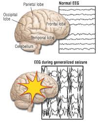 Absence seizures (also called petit mal seizures). Generalized Seizures Grand Mal Seizures Harvard Health