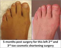 Cosmetic surgery can be performed on any part of the face and body. Cosmetic Foot Surgery Home Facebook