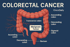 Image result for Colorectal Cancer