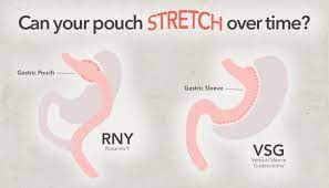 The result is a sleeve or tube like structure. Will The Stomach Stretch After Bariatric Surgery Mccarty Weight Loss