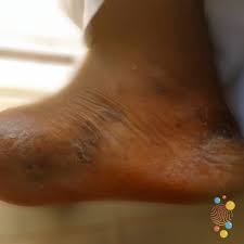 Image result for dyshidrosis