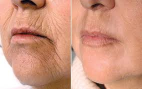 Jato de Plasma, Rejuvenescimento Facial Express - Studio Ensō