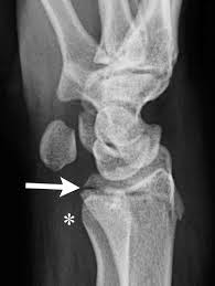 Check spelling or type a new query. Pediatric Distal Forearm And Wrist Injury An Imaging Review Radiographics