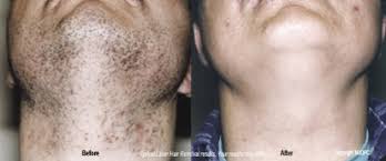 Founded in 1786 and incorporated as a city in 1929, dearborn, michigan is the eighth largest city in the state, and the second largest city in wayne county. What Do We Do Zara Laser Hair Removal Skincare