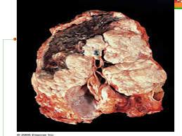 Malignant mesothelial cells are either of epithelioid (epithelioid subtype) or spindled (sarcomatoid / desmoplastic subtype) cytology or a combination thereof (biphasic) if biphasic: Pathology Of Pleura Laboratory Investigations In Lung Diseases Ppt Download