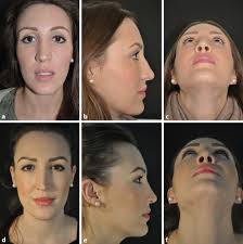 Hier entsteht eine neue webseite! Figure 2 Rhinoplastik Springerlink